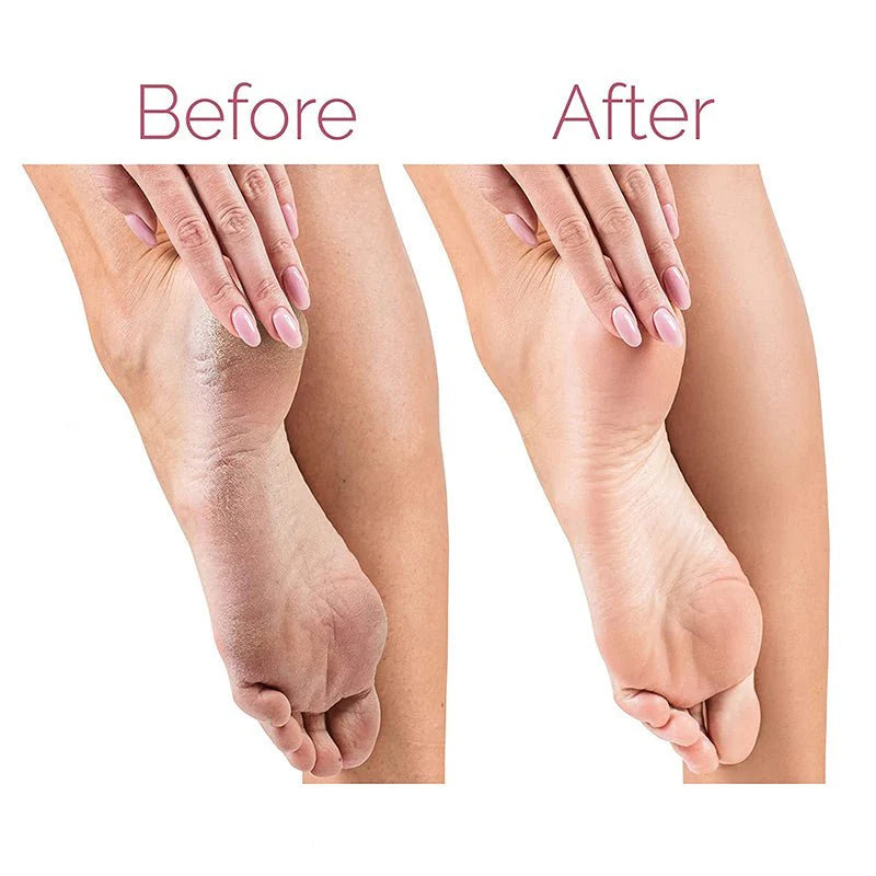 Electric Pedicure Foot File – Rechargeable Callus Remover for Smooth Feet